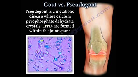 Gout And Pseudogout Joint Pain Everything You Need To Know Dr Nabil