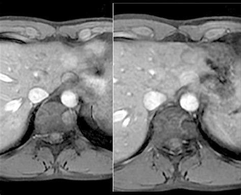 Multiple Images Of The Aorta Ghosting Artifact Caused By Aortal