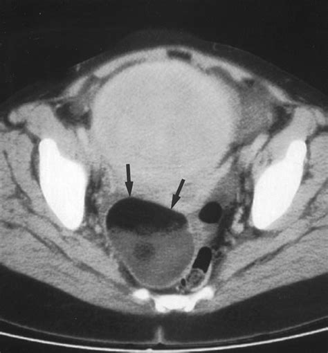 Intraperitoneal Rupture Of A Benign Cystic Ovarian Teratoma Findings At