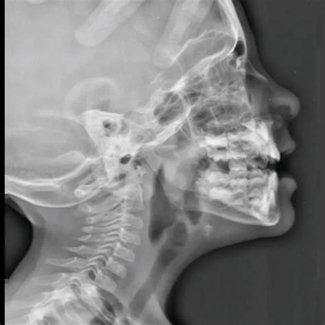 X Ray Nasal Bone LAT View Test Price In Delhi Ganesh Diagnostic
