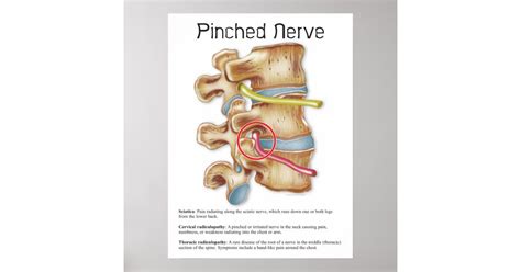 Pinched Nerve Physical Therapy Chiropractic Chart Zazzle