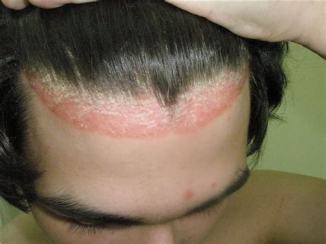 Psoriasis On Face Photos Symptoms And Pictures
