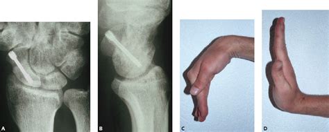 38 Corrective Osteotomy For Scaphoid Malunion Musculoskeletal Key