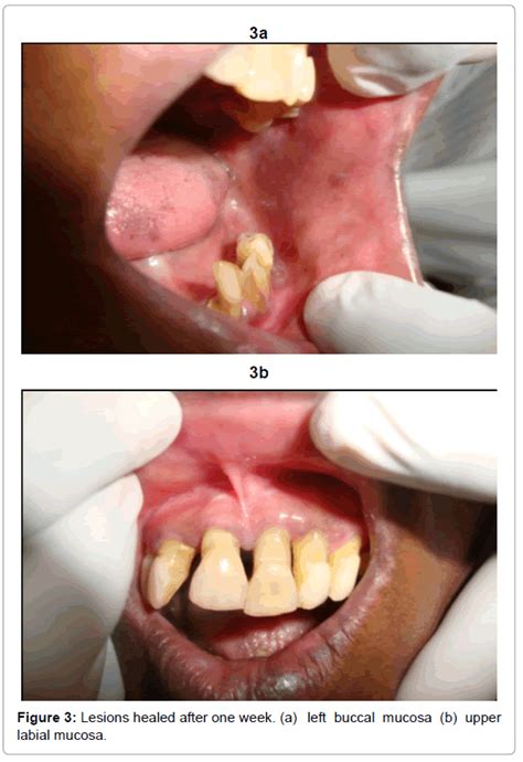 Stomatitis Medicamentosa A Case Report With Review Omics International