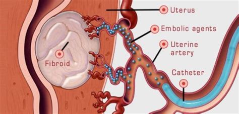 Fibroids And Uterine Fibroid Embolization Fibroid Institute Dallas