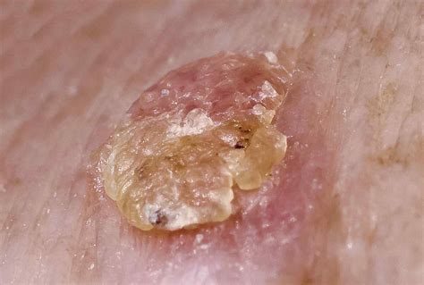 The lesion may rupture, bleed and scab over. About Skin Cancer - Mobile Skin Doctors