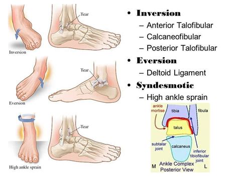 The type and grade of ankle sprain you suffer can tell you a lot about how long you might be sidelined by this injury. Pin by Ashtyn Turner on ACAM III MSK | Sprained ankle ...