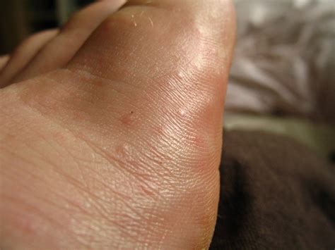 Little Bumps On Foot Flickr Photo Sharing