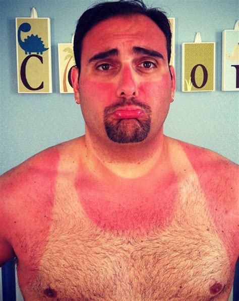 Weird And Funny Sunburns 18 Pics