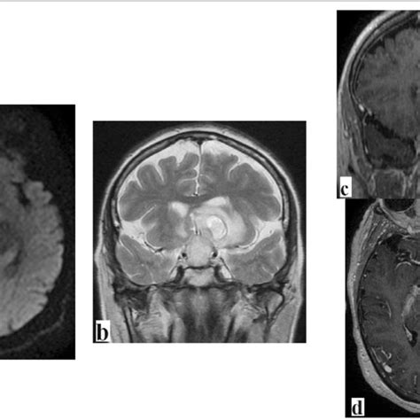 Brain Magnetic Resonance Imaging Scans A Diffusion Weighted Imaging