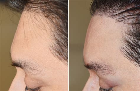 Forehead Implants Before And After