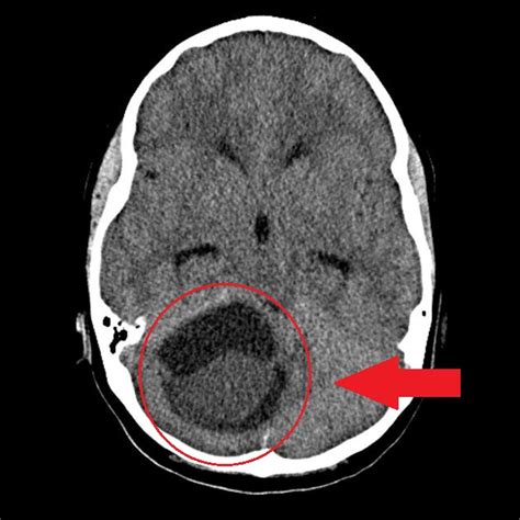 Astrocytoma Ct Wikidoc