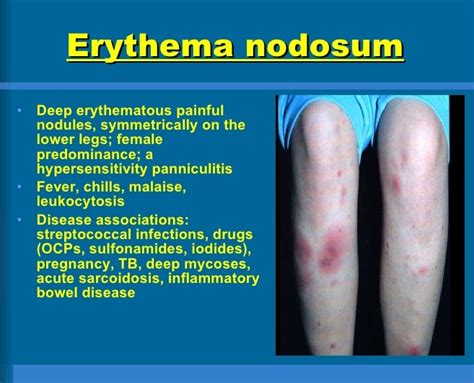 Erythema Nodosum Causes Pictures Photos