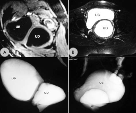 A T1 Weighted Mri Image Showing The Urethral Diverticulum Ud And