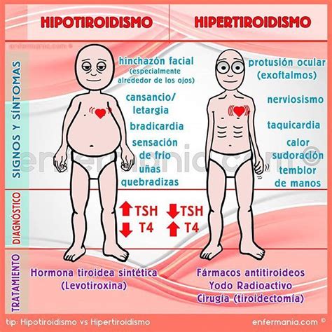 Hipotiroidismo E Hipertiroidismo Diferencias My Xxx Hot Girl