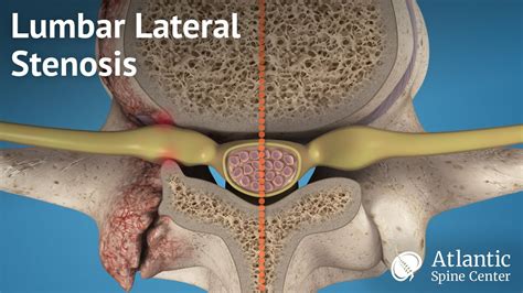 Lumbar Lateral Stenosis Overview YouTube