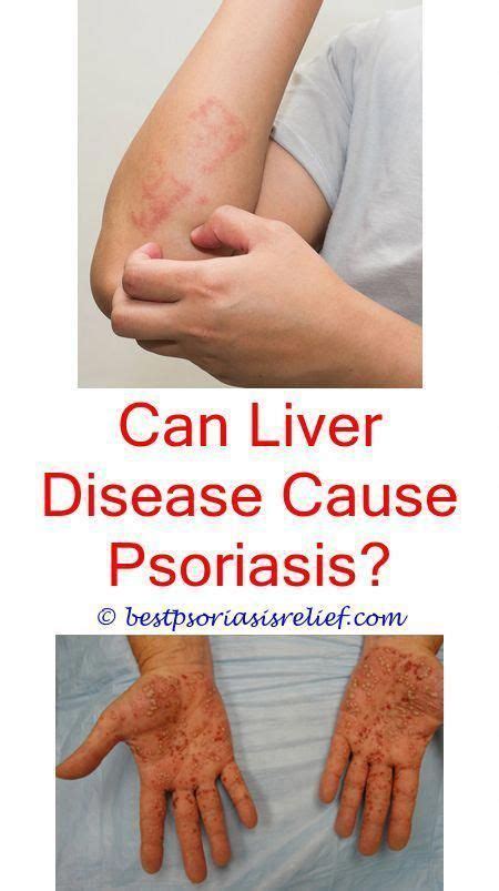 Everything You Need To Know About Psoriasis Psoriasis On Face