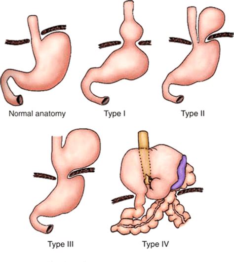 Figure 2 From Massive Hiatal Hernia A Review Semantic Scholar