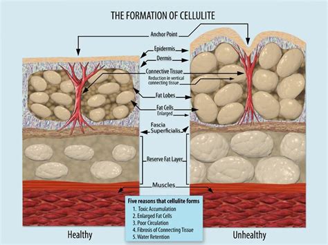 Cellulite Causes Symptoms Prevention And Treatment Skinpractice
