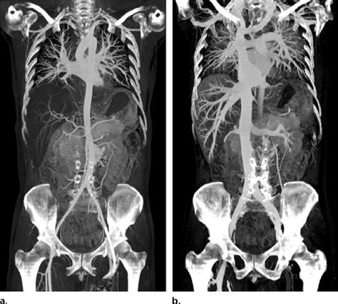Arterial And Venous Postmortem Ct Angiography Of The Thorax And