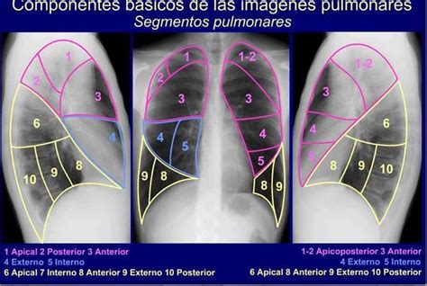 How To Interpret A Chest X Ray Lesson 6 Diaphragm And Pleura Artofit