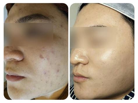 Active Acne And Scars Mz Clinic