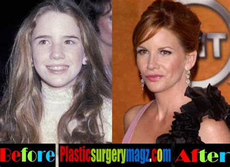 Melissa Gilbert Plastic Surgery Breast Implant Removal And Lift