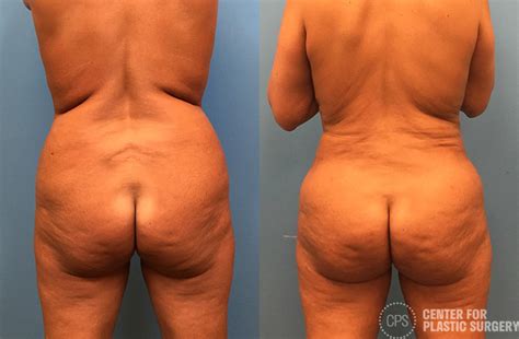 Brazilian Butt Lift Before After Photo Gallery Annandale