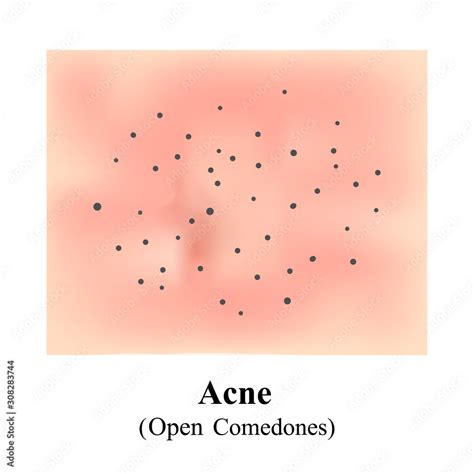 Acne Open Comedones Skin With Blackheads Black Spots Acne On The