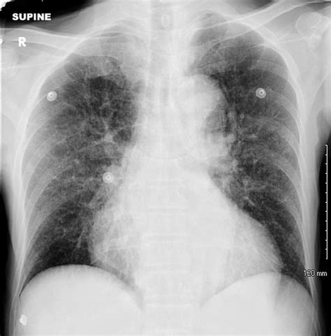 Hypercalcaemia Atypical Presentation Of Miliary Tuberculosis So And