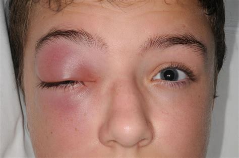Periorbital Swelling Of The Right Eye Preseptal Cellulitis Grepmed