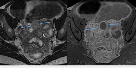 Axial T2 Weighted And Contrast Enhanced T1 Weighted Mri Pelvis Showing