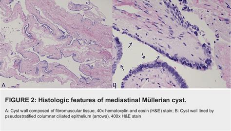 Figure 2 from Müllerian Cysts of the Posterior Mediastinum A Case