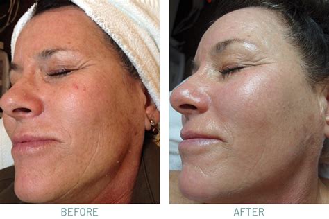 Microdermabrasion And Chemical Peels Natural Skincare Clinic