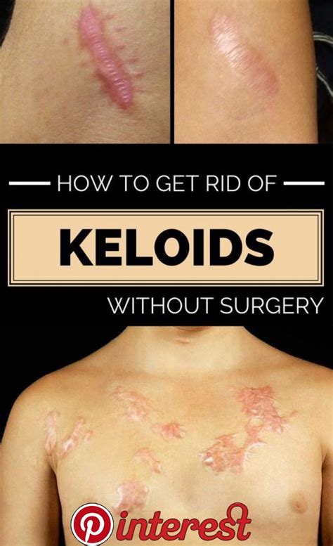 How To Get Rid Of Keloids Without Surgery Wellnes