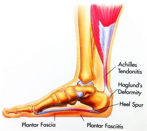 Heel Spur Syndrome Foot And Ankle Doctors Inc