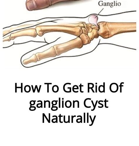 How To Heal Ganglion Cysts Margaret Greene Kapsels The Best Porn Website