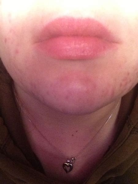 Acne Troubles Around My Chin Cheeks Beautylish