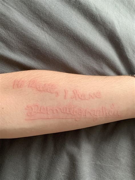 I Have A Rare Skin Condition Allowing Me To Draw On My Self