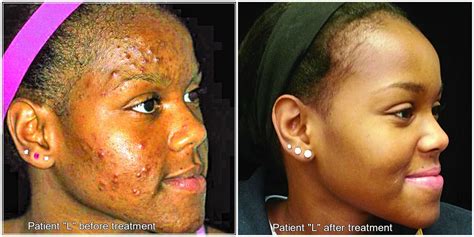 What You Should Know About Acne Mn Spokesman Recorder Msr News Online