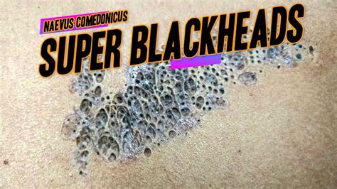 Super Blackheads Naevus With Comedone Extractor Tools Youtube
