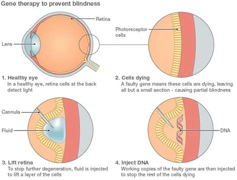 Gene Therapy Could Be Used To Treat Blindness Bbc News
