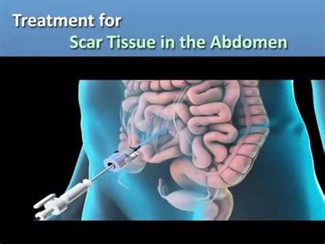 Treatment For Scar Tissue In The Abdomen Youtube
