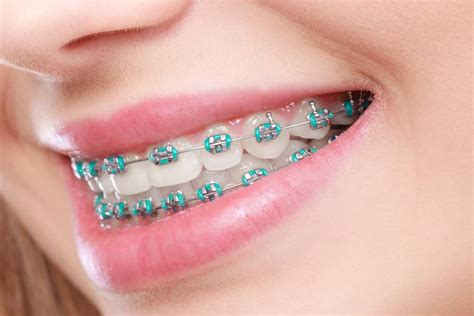 Are Custom Braces Worth The Cost Orthodontist In Fort Collins Co