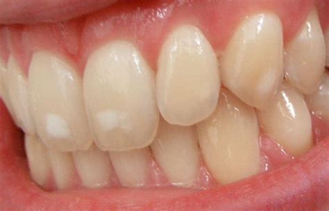 White Streaks On Teeth After Whitening Teethwalls