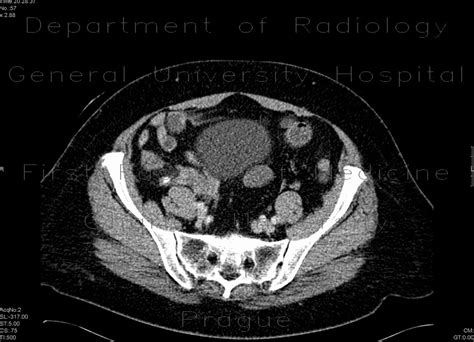 Radiology Case Appendicitis Appendicolith