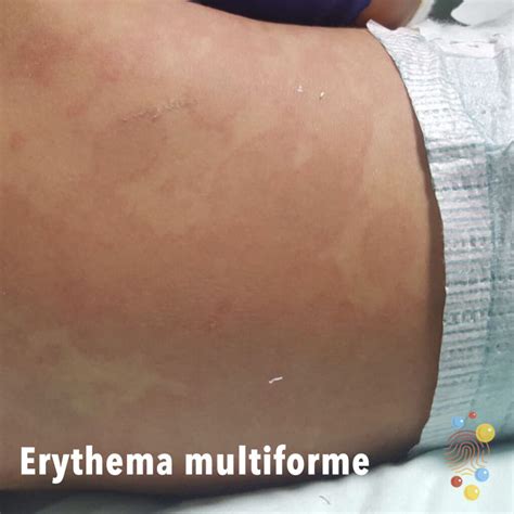 Erythema Multiforme Skin Deep
