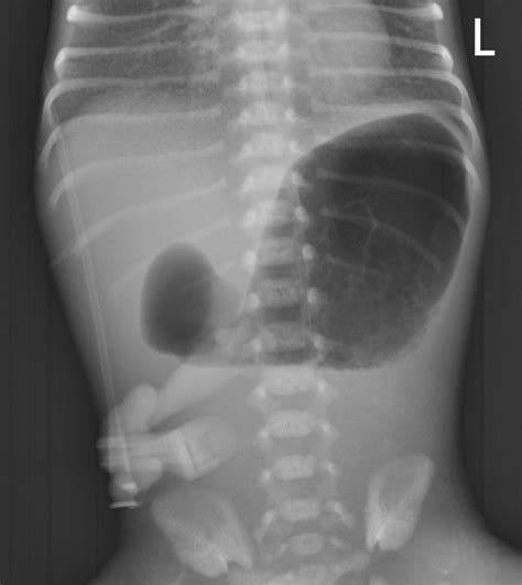 A Neonate With Bilious Emesis The Bmj