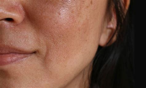 Melasma Conheça As Causas E Tratamentos