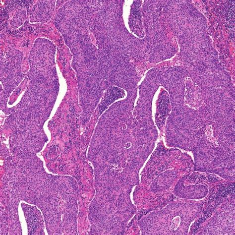 Moderately Differentiated Squamous Cell Carcinoma Hande 71× Download